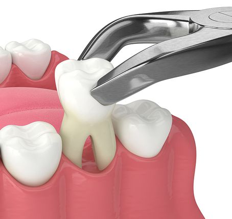 Wisdom Teeth Extractions Wisdom Teeth Extractions